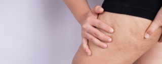 Почему появляется целлюлит и как от него избавиться