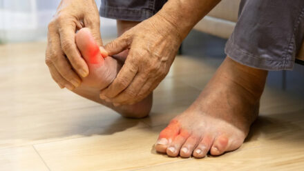 Подагра и гиперурикемия: интегративный подход к снижению мочевой кислоты