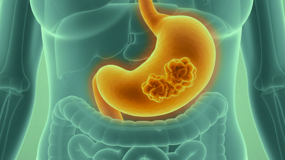 Питание при гастрите и язве желудка: разрешенные продукты и примерное меню