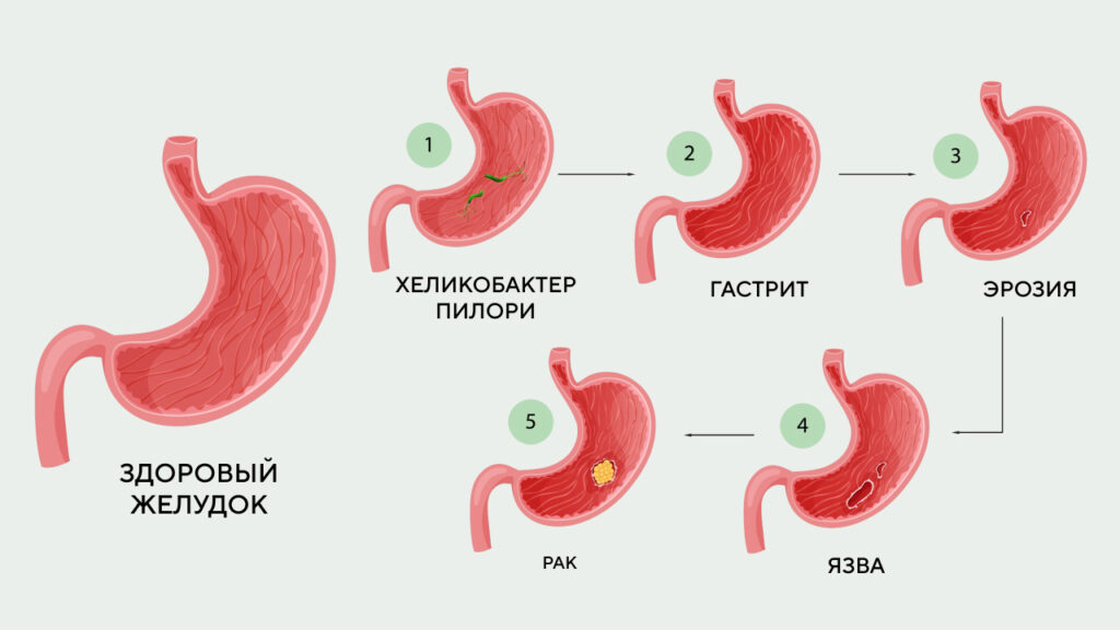 При язве слизистая повреждена глубже, поэтому щадящий режим длится от шести до двенадцати месяцев, при остром гастрите — две-четыре недели